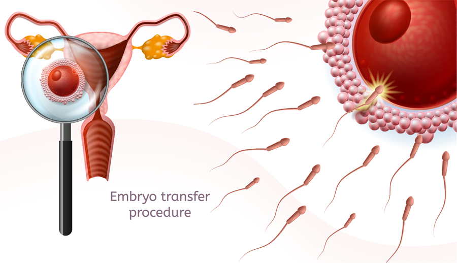 Embryo Transfer